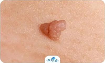 ریمو تخصصی  زگیل و... در چابهار