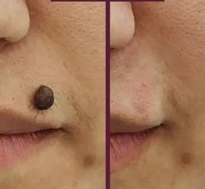 پاک کردن منگوله وخال در ایلام