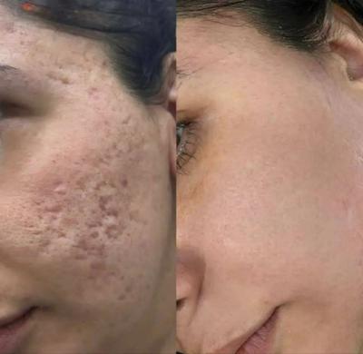 رفع انواع لک پوستی و چین وچروک در یزد