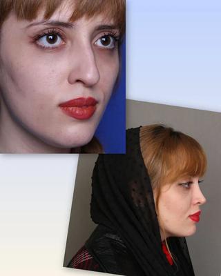 جراحی زیبایی بینی در مرکز زیبایی البرز تهران در تهران