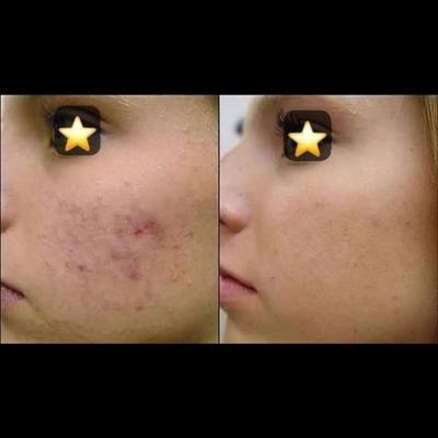 ضد جوش و آنتی آکنه و ضدلک بیوممتیک در کرج