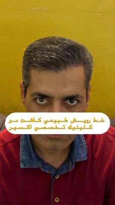 کاشت مو ابرو ریش کلینیک تخصصی اکسیر اقساطی در تبریز