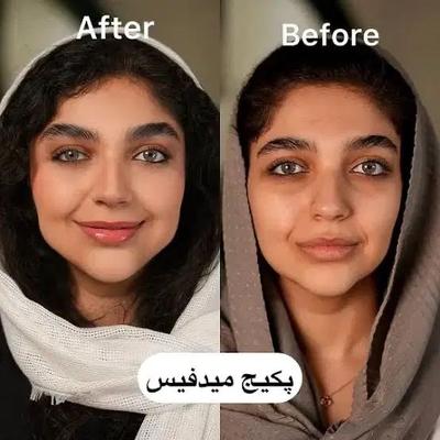 ۳۰٪تخفیف کمبوتکنیک چهره با خدمات رایگان توسط پزشک در قم