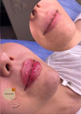 جوانسازی و زیبایی صورت با تزریق ژل و فیلر در شیراز