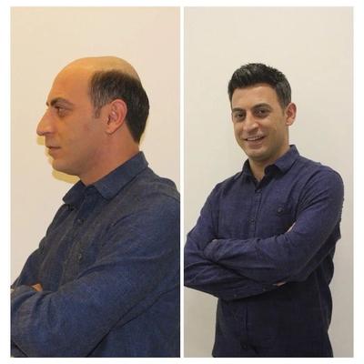 کاشت مو با اقامت رایگان در شیراز در شیراز