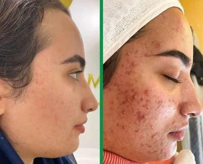 زیبایی/ر رفع جوش/ لاغری در اصفهان