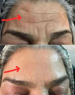 بوتاکس را فراموش کن در تهران