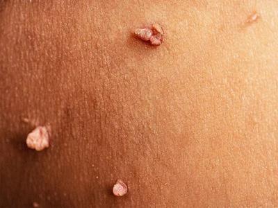 رفع و درمان زگیل و hpv در مشهد