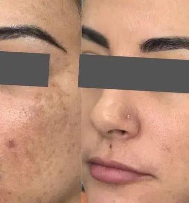 پک کرم و صابون ضدلک و روشن کننده صورت اصل در یاسوج