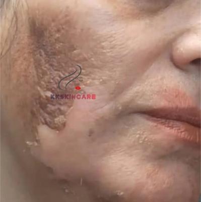 حذف لک و کک ومک وپینه پا بانوان و اقایان در بکان