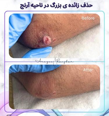 مشاوره رایگان%زگیل تناسلی% آقایان بانوان در اصفهان در اصفهان