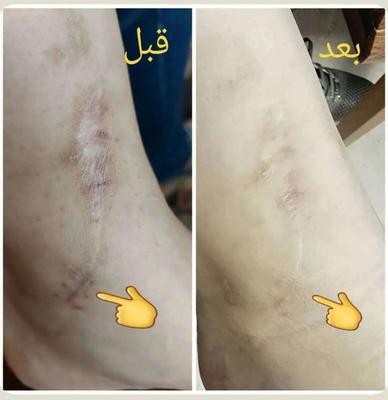 ترمیم اسکار و رفع رد بخیه و جای جوش در مشهد
