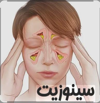 سینوزیت و تخلیه بدون جراحی در شیراز