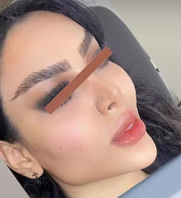 غبغب پیکرتراشی ژل بوتاکس بلفاروپلاستی تزریق چربی در تهران