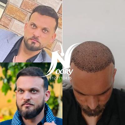کاشت مو و ابرو در تهران