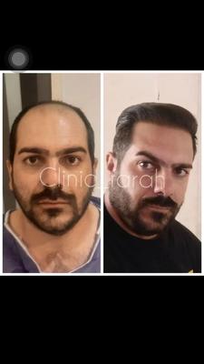 کاشت مو و ابرو اقساطی کار کاشت توسط پزشک در تهران