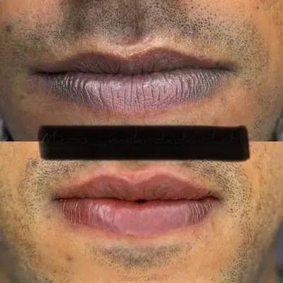 درمان کم پشتی ابرو تیرگی لب آقا لیزرموی زائد مطب در قم