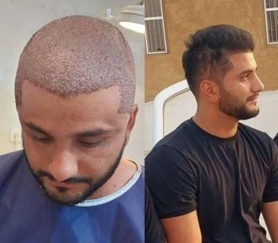 کاشت مو و ابرو فول تراکم فقط ۱۲ میلیون در زنجان