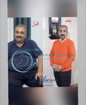 لاغری اسلیو معده با دکتر یرانی جراح با تجربه در تهران