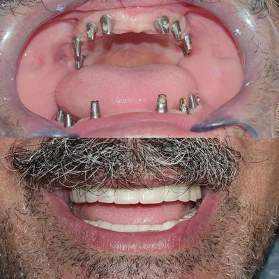 دندانپزشکی، کاشت ایمپلنت ،ونیر کامپوزیت و لمینت در مشهد