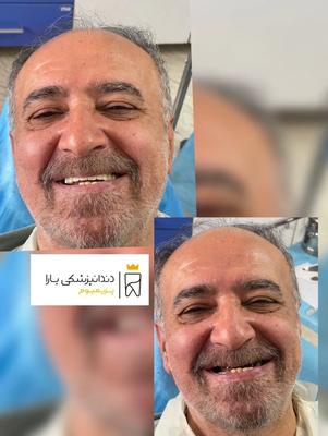 ایمپلنت یکروزه دیجیتال بدون درد
اقساط ۱۲ ماه بیمه
۰۹۳۰۶۹۵۷۰۵۰ در تهران