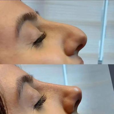 بهترین خدمات زیبایی ژل بوتاکس فیلر مزوژل لیزر در شیراز