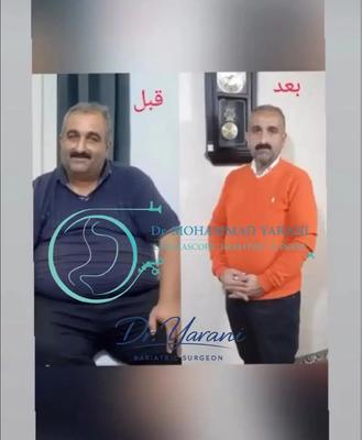 لاغری اسلیو معده_بایپس فلوشیپ فوق تخصصی جراحی لاپاراسکوپی و لاغری در قزوین