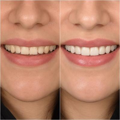 کامپوزیت دندان در اصفهان+پرداخت اقساطی در اصفهان