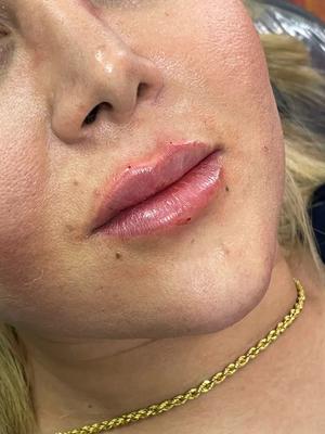 تزریق ژل لب،فیلرلب،بوتاکس،زاویه سازی،پی ارپی در کرج