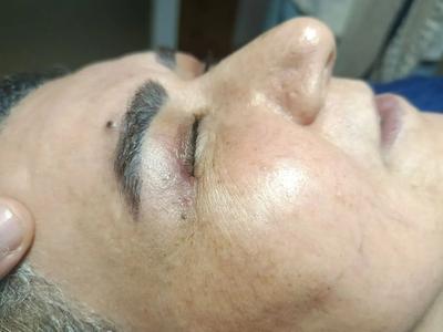 لیفت شقیقه . جراحی پلک بلفاروپلاستی در ساری