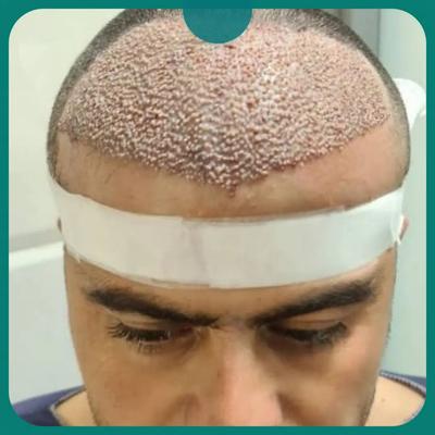 شرایط ویژه کاشت مو ابرو ریش دریافت مشاوره رایگان با شماره 09351043469 در شیراز