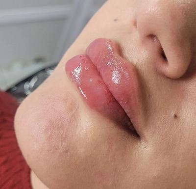 بوتاکس چروک صورت و بوتاکس تعریق،ژل صورت و بدن،لیزرموی زائد،خالبرداری در ساری