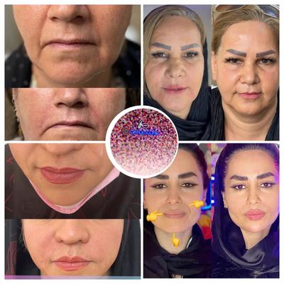 جشنواره تخفیف لیزر تزریق ژل و بوتاکس در تهران