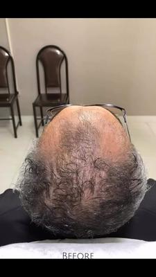 ریزش مو کلافه‌ت کرده؟ 😩💇🏻‍♀️ در تبریز