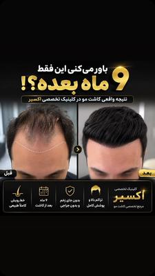 اگر از ریزش مو یا کم‌پشتی خسته شدی، وقتشه برای یک مشاوره تخصصی اقدام کنی. در تبریز