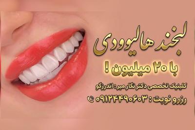 لبخندی زیبا با پیش پرداخت فقط ۲۰ میلیون تومان برای هر فک کامپوزیت ونیر در تهران